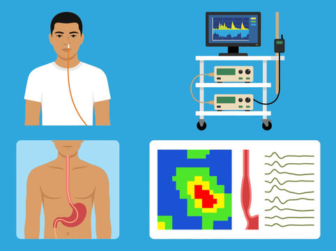 Esophageal Manometry Medical Procedure Illustration for High-Resolution Manometry HRM Diagnostic Test and Gastrointestinal Motility Analysis