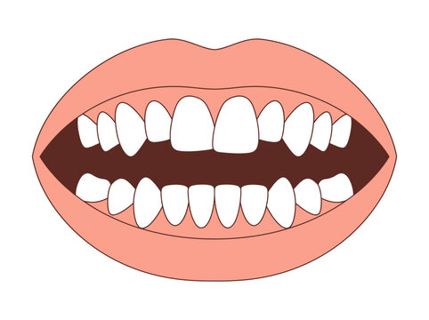 Orthodontic Illustration of Crowded and Misaligned Teeth, Dental Malocclusion Diagram for Healthcare and Education