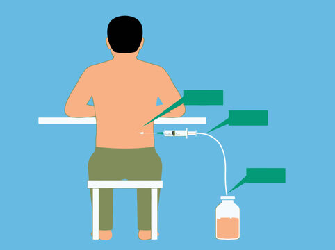 Medical Illustration of a Lumbar Puncture Procedure showing Spinal Tap Technique with Cerebrospinal Fluid Collection and Label Placeholders
