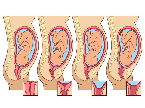 Medical Illustration of the Stages of Cervical Effacement and Dilation During Childbirth