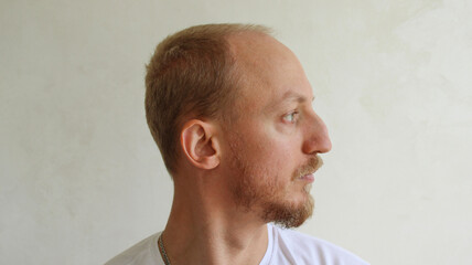 Side profile portrait of man before rhinoplasty plastic surgery medical concept © eliyashevskiy