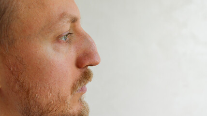 Close up side profile view of man with aquiline nose before rhinoplasty surgery © eliyashevskiy