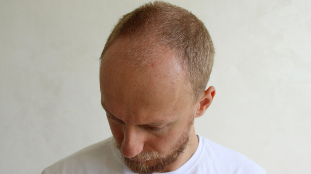 Male pattern baldness, thinning hair, and receding hairline on young man head top view