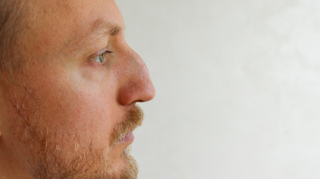 Close up side profile view of man with aquiline nose before rhinoplasty surgery