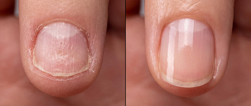 Macro Comparison of Damaged Fingernail with Longitudinal Ridges and Healthy Smooth Manicured Surface