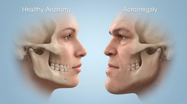 Healthy Skull Anatomy vs Acromegaly Comparison