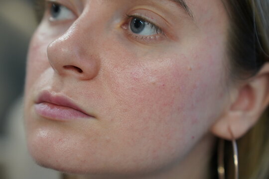 Close‑up of young woman&rsquo;s facial skin two hours after biorevitalization cosmetic procedure, with papules and bumps on the epidermis. Skin care treatment of redness chapping rosacea irritation acne