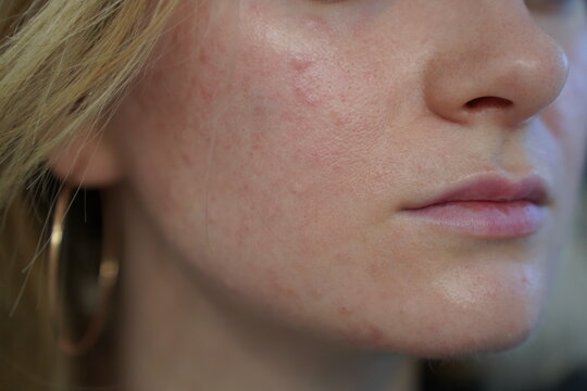 Close‑up of young woman&rsquo;s facial skin two hours after biorevitalization cosmetic procedure, with papules and bumps on the epidermis. Skin care treatment of redness chapping rosacea irritation acne