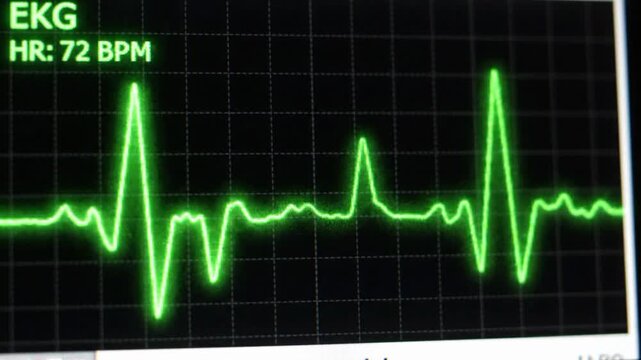 Second loop of heart monitor EKG with alpha a VSRExport