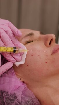Vertical video. Beauty injection. Therapy treatment. Professional hand making botulinum toxin facial skin procedure for woman in salon using cotton pads.