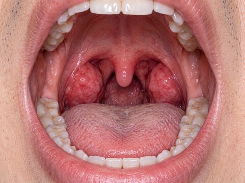 Close-up of red swollen tonsils inside an open mouth