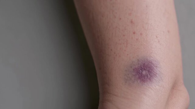 Forearm exhibits purple contusion marks developing gradually across human skin. Uncomfortable physical trauma appears around arm joint, showing painful swelling in clinical studio lighting.