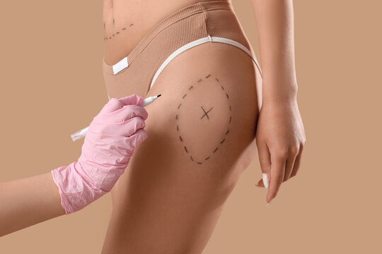 Plastic surgery consultation, surgeon marking patient hip for liposuction procedure with surgical pen on skin for body contouring and aesthetic correction