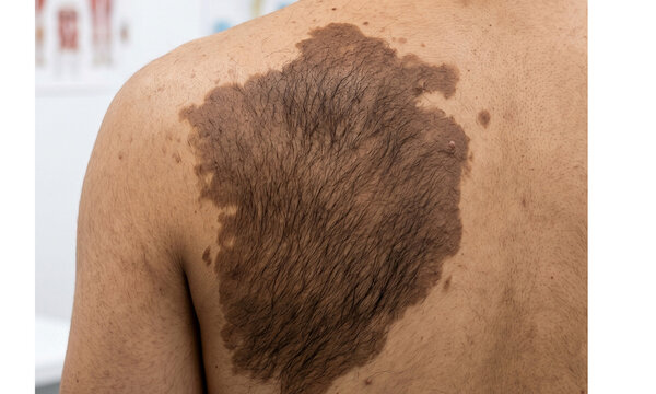 Clinical Photograph Showing Hyperpigmented Patch with Hypertrichosis on Shoulder/Upper Back Region - Becker Nevus - Becker Melanosis