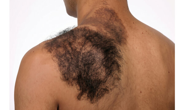 Dense curly terminal hair growth on Pigmented Neck and Shoulder Skin - Becker Nevus ( Becker Melanosis ) with excessive hair