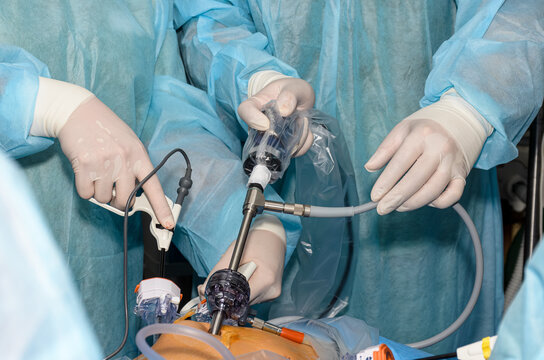Surgical team adjusting an endoscopic camera system during laparoscopic surgery.