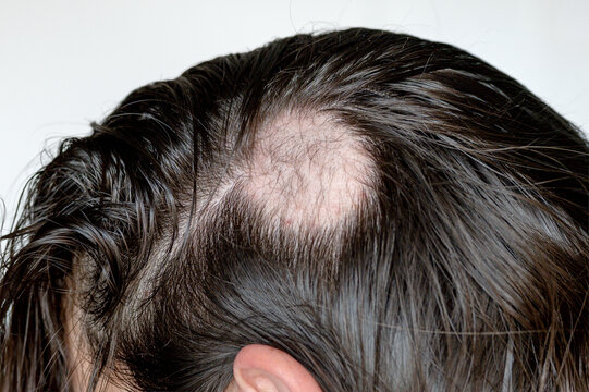 Close-up of alopecia areata during hair regrowth, with fine new hairs visible within a recovering bald patch.