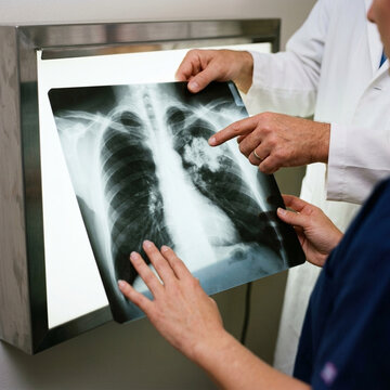 Medical Professionals Reviewing Chest X ray Film on Lightbox