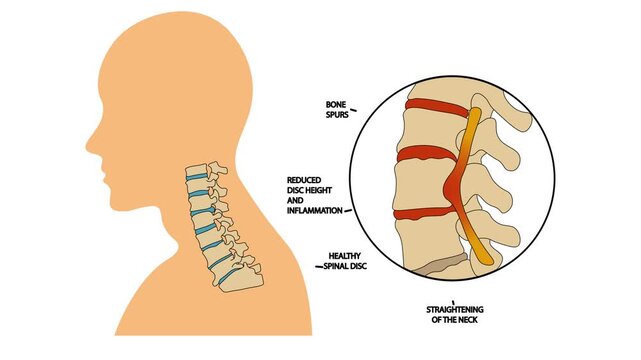Medical vector animation displaying cervical spine anatomy with a magnified view of vertebrae illustrating bone spurs, disc height reduction, inflammation, and nerve compression