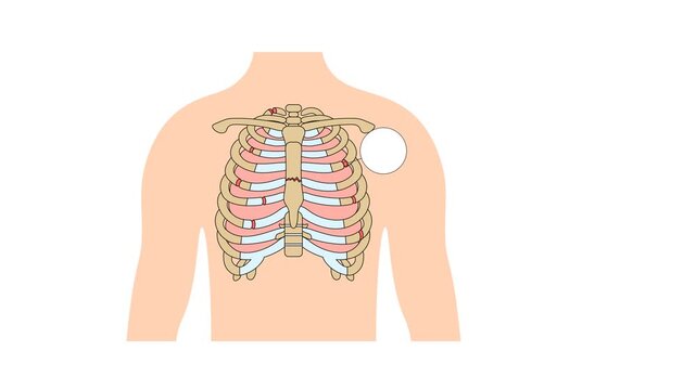 Medical vector animation displaying thoracic cage skeletal anatomy with a fractured sternum and a magnified cross-section view of a displaced broken rib bone, highlighting rib fracture, flail chest