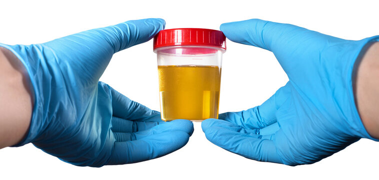 Two gloved hands holding urine sample container for medical testing, isolated on transparent cutout background