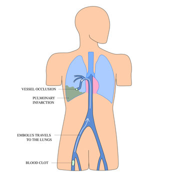 Pulmonary Embolism