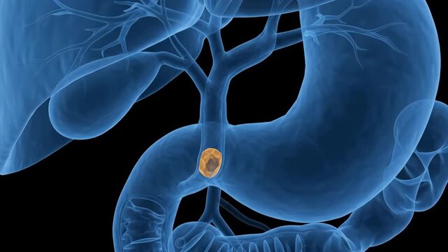 3D visualization of gallstone obstruction in the bile duct for medical education and anatomical clinical training purposes
