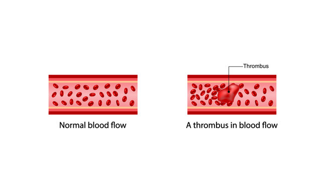 Thrombosis, formation of a blood clot a thrombus inside a blood vessel which slows or blocks normal blood flow. Scientific diagram. Vector illustration.