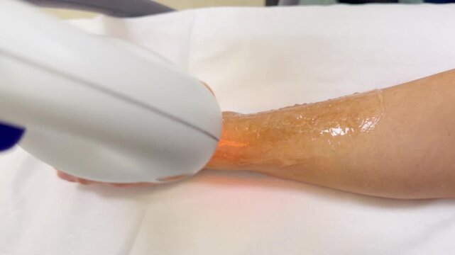 Doctor Hand in Glove Holding IPL Handpiece During Phototherapy Treatment on Patient Arm &ndash; Intense Pulsed Light Procedure with Light Flashes