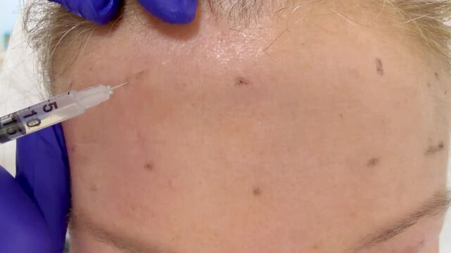 Doctor Hand in Glove Injecting  into Patient Forehead with Syringe &ndash; Cosmetic Botulinum Toxin Procedure Close Up