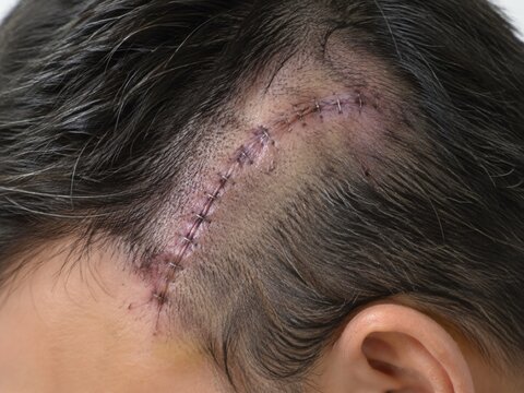 A detailed scalp closeup shows metal staples securing a curved incision amid partially shaved hair.
Concept of postoperative wound healing.