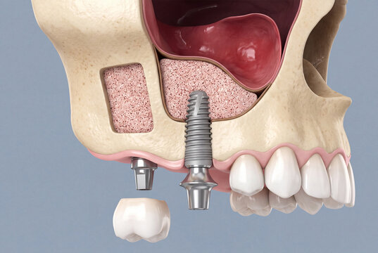 Sinus lift surgery with dental implant placement, 3D medical illustration of bone graft in maxillary sinus, lateral window and titanium implant with abutment and crown