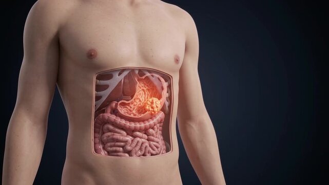 Human anatomy illustration showing stomach cancer tumor inside abdomen with detailed digestive organs and intestines in medical illustration highlighting digestive system organ