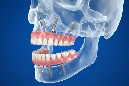 Full mouth rehabilitation with implant-supported dentures, exploded view of maxilla and mandible with eight screws and prosthesis, medical 3D render