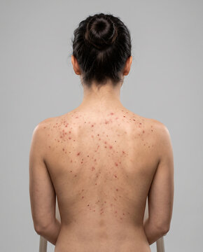Back view of young woman with severe bacne skin breakouts pimples on back