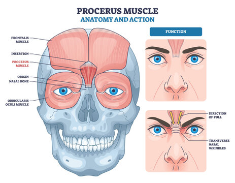 Procerus muscle outline shows facial anatomy and action, highlighting procerus, nasal bone, and forehead wrinkles for frown expression and pull direction. Outline diagram