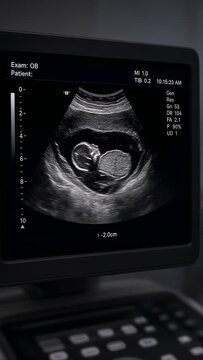 Pregnancy Ultrasound showing a baby