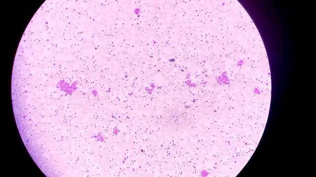 Thrombocytosis. Platelet increased in number. Microscopic footage of complete blood count (CBC). 
