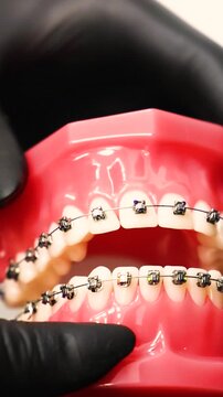 Gloved hand holding a dental model jaw fitted with metal braces brackets