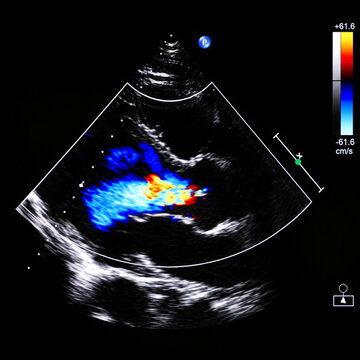 Echocardiogram ultrasound scan displaying a heart valve with color doppler flow