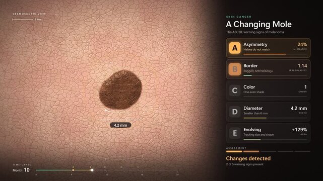 Skin cancer melanoma mole changing over time abcde warning signs dermoscopy 4k loop