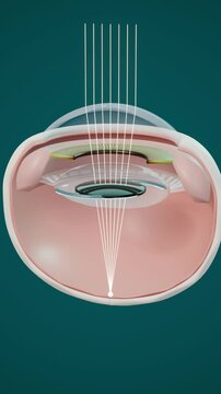 Intraocular lens unfolding inside the eye after cataract surgery and focusing light on the retina, vertical video loop