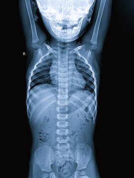 Pediatric Chest and Abdomen X-Ray Showing Skeletal Cage Spine and Ribs   