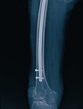 Distal Femur X-Ray Showing Intramedullary Nail and Distal Interlocking Screws Fixation   