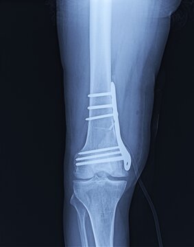 Distal Femur Fracture Repair X-Ray Demonstrating Lateral Locking Compression Plate Fixation   
