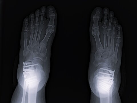Bilateral Axial Calcaneal Tangential View X-Ray Showing Heel Bone Internal Fixation   