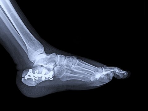 Lateral Calcaneal Plate and Screw Fixation Radiograph for Comminuted Heel Fracture   