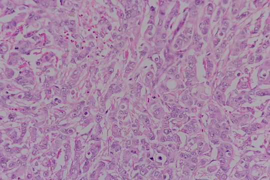 Backgrounds of human cells tissue of lung human under the microscope in pathology lab.View in microscopic of ductal cell carcinoma, adenonocarcinoma from human breast cancer, tissue section by H and E