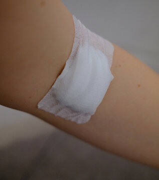 Gauze dressing on the inner elbow after a blood draw. Arm with a gauze dressing at the inner elbow after a blood test