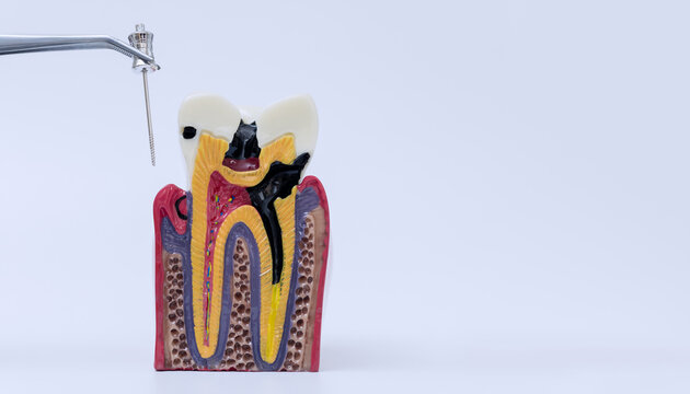 Endodontic treatment concept showing metal tweezers holding a dental file near a cross section anatomical model of a decayed tooth with copy space.